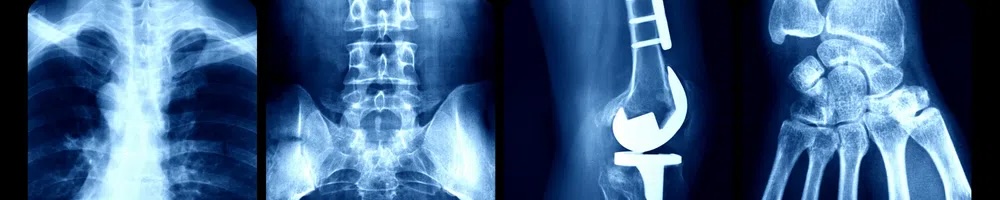 Four X-rays side by side: chest, pelvis, knee, and foot.