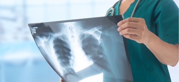 A medical professional reviews an X-ray of the lungs for a patient.