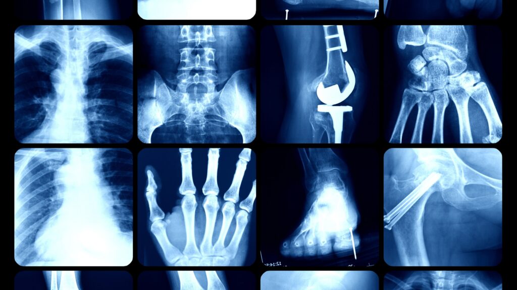 A collection of various patient X-rays and joint replacements.